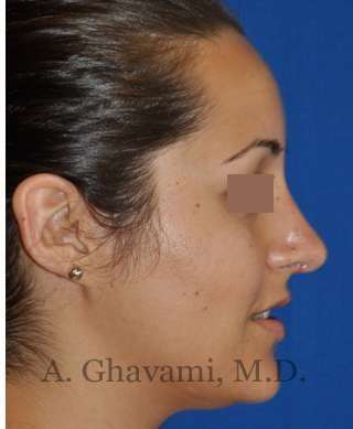 Rhinoplasty Before & After Patient #7202