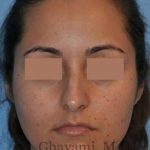 Rhinoplasty Before & After Patient #7202