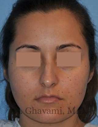 Rhinoplasty Before & After Patient #7202