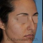 Rhinoplasty Before & After Patient #7202