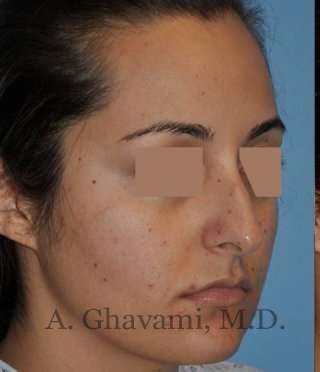Rhinoplasty Before & After Patient #7202