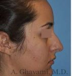 Rhinoplasty Before & After Patient #7202