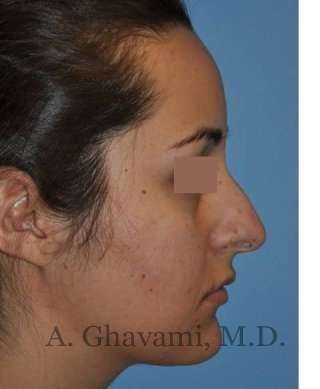 Rhinoplasty Before & After Patient #7202