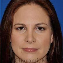 Revision Rhinoplasty Before & After Patient #7186