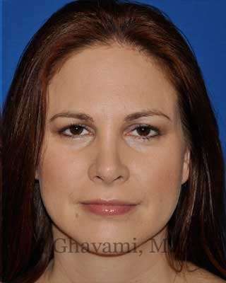 Revision Rhinoplasty Before & After Patient #7186