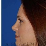 Revision Rhinoplasty Before & After Patient #7186