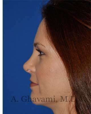 Revision Rhinoplasty Before & After Patient #7186