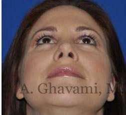 Revision Rhinoplasty Before & After Patient #7186