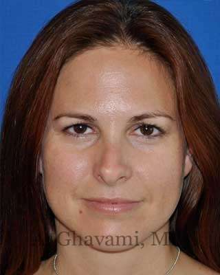 Revision Rhinoplasty Before & After Patient #7186