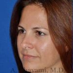 Revision Rhinoplasty Before & After Patient #7186