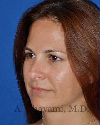 Revision Rhinoplasty Before & After Patient #7186
