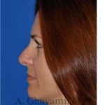 Revision Rhinoplasty Before & After Patient #7186