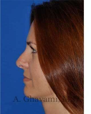 Revision Rhinoplasty Before & After Patient #7186
