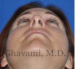 Revision Rhinoplasty Before & After Patient #7186