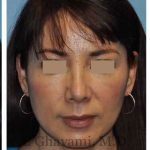 Rhinoplasty Before & After Patient #7177