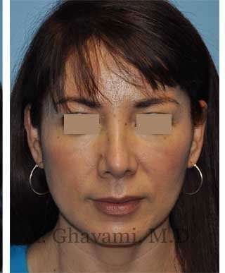 Rhinoplasty Before & After Patient #7177