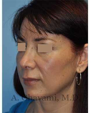 Rhinoplasty Before & After Patient #7177