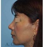 Rhinoplasty Before & After Patient #7177