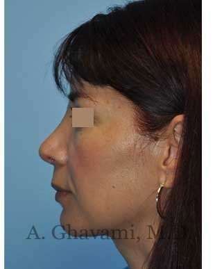 Rhinoplasty Before & After Patient #7177