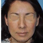 Rhinoplasty Before & After Patient #7177