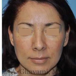 Rhinoplasty Before & After Patient #7177