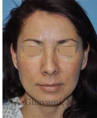 Rhinoplasty Before & After Patient #7177