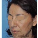 Rhinoplasty Before & After Patient #7177