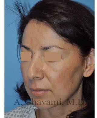 Rhinoplasty Before & After Patient #7177