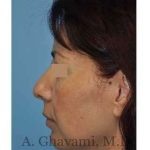 Rhinoplasty Before & After Patient #7177