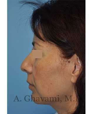 Rhinoplasty Before & After Patient #7177