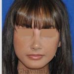 Rhinoplasty Before & After Patient #7161