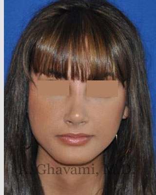 Rhinoplasty Before & After Patient #7161