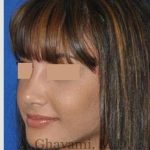 Rhinoplasty Before & After Patient #7161