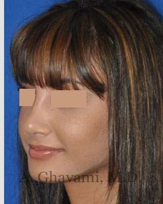 Rhinoplasty Before & After Patient #7161