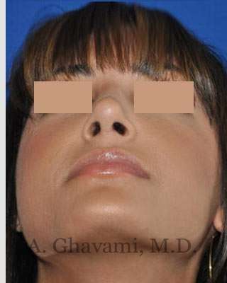 Rhinoplasty Before & After Patient #7161