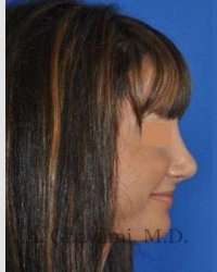 Rhinoplasty Before & After Patient #7161