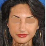 Rhinoplasty Before & After Patient #7161