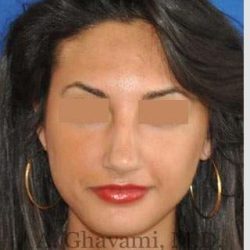 Rhinoplasty Before & After Patient #7161