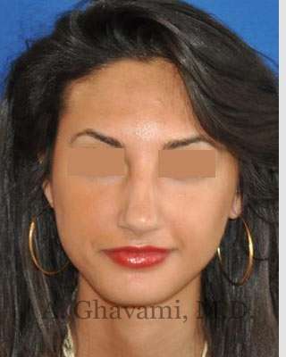 Rhinoplasty Before & After Patient #7161