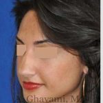Rhinoplasty Before & After Patient #7161