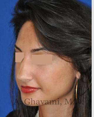 Rhinoplasty Before & After Patient #7161