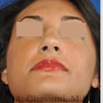 Rhinoplasty Before & After Patient #7161