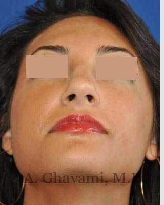 Rhinoplasty Before & After Patient #7161