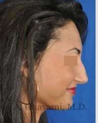 Rhinoplasty Before & After Patient #7161