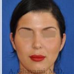 Ethnic Rhinoplasty Before & After Patient #7152