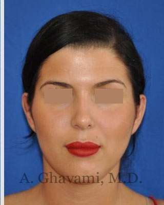 Ethnic Rhinoplasty Before & After Patient #7152