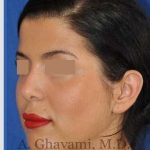 Ethnic Rhinoplasty Before & After Patient #7152