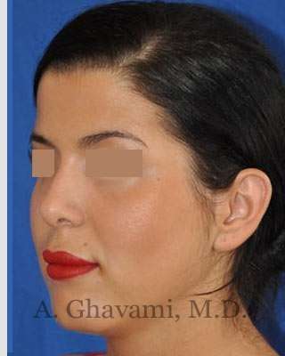 Ethnic Rhinoplasty Before & After Patient #7152