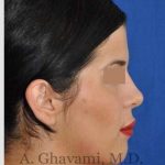 Ethnic Rhinoplasty Before & After Patient #7152