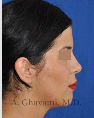 Ethnic Rhinoplasty Before & After Patient #7152